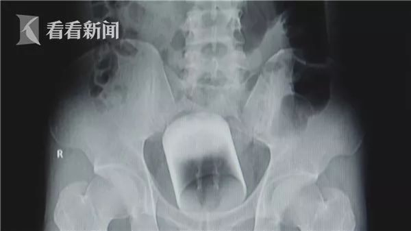 肛门塞入玻璃杯
